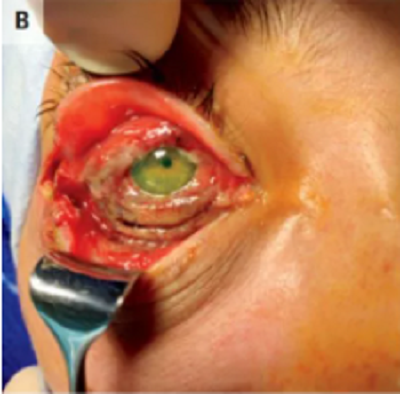 benh dau mua bo 2