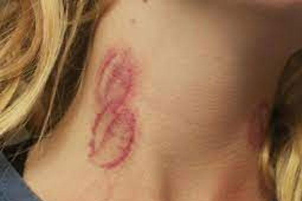 hickey