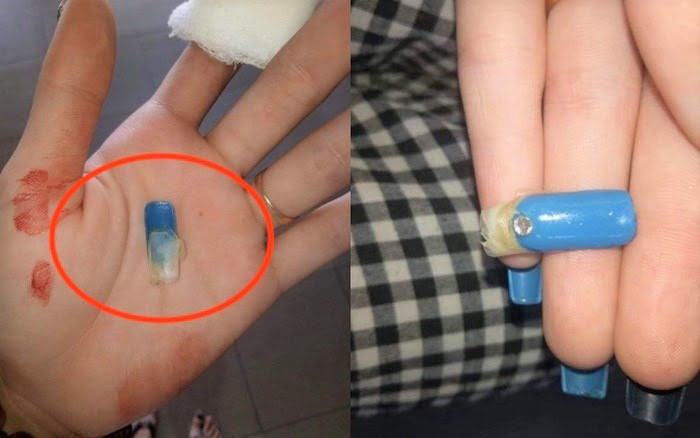 rot mong gel