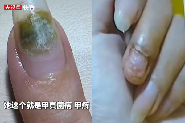 nhiem hpv